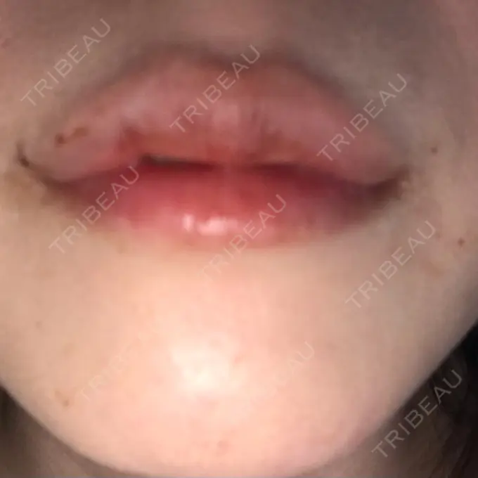 ヒアルロン酸注入（唇） LIKI CLINIC KOBE DAY 7 メイン用