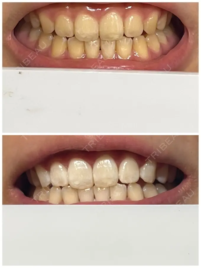 ホワイトニング SK新宿歌舞伎町美容外科・歯科 DAY 2 メイン用