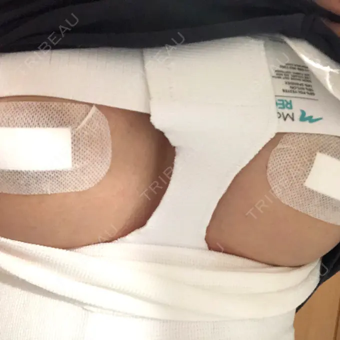 豊胸（シリコンバッグ） ジョウクリニック 那覇院 DAY 1 メイン用