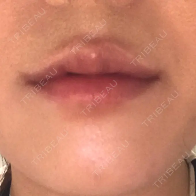 ヒアルロン酸注入（唇） LIKI CLINIC KOBE DAY 9 メイン用