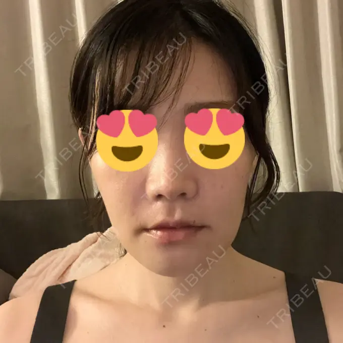 セットバック カトレア歯科・美容クリニック DAY 7 メイン用