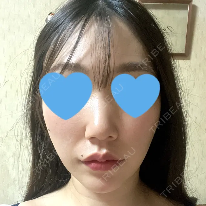 糸リフト / 脂肪吸引（顔） 湘南美容クリニック 長野院 AFTER メイン用