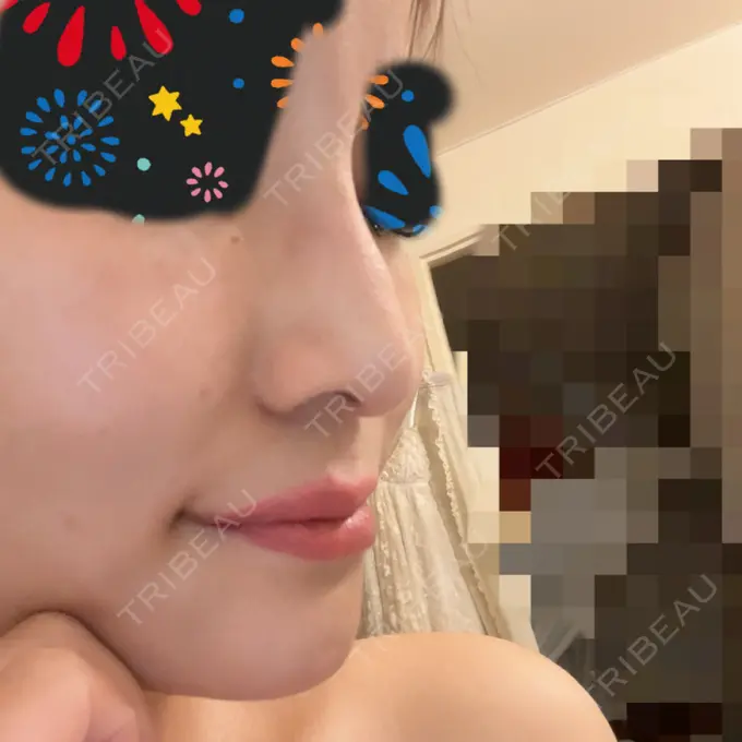 ボトックス（エラ・小顔） / 美容点滴・美容注射（疲労回復） / その他（鼻） HAAB×DREAM BEAUTY CLINIC 東京本院 AFTER メイン用