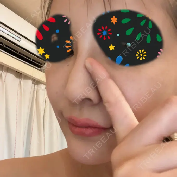 ボトックス（エラ・小顔） / 美容点滴・美容注射（疲労回復） / その他（鼻） HAAB×DREAM BEAUTY CLINIC 東京本院 DAY 47 メイン用