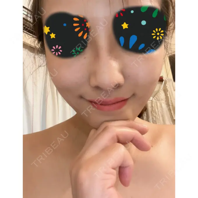 ボトックス（エラ・小顔） / 美容点滴・美容注射（疲労回復） / その他（鼻） HAAB×DREAM BEAUTY CLINIC 東京本院 DAY 47 メイン用