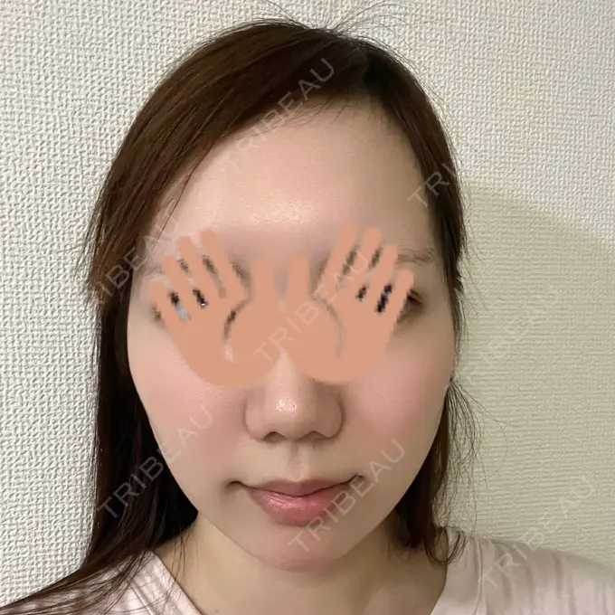 あごプロテーゼ WOM CLINIC GINZA （ワム クリニック ギンザ） DAY 49 メイン用