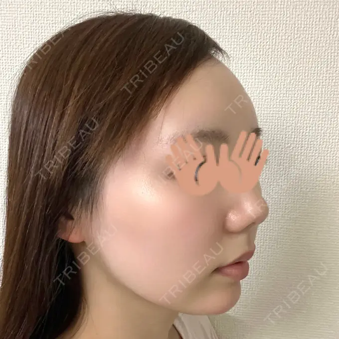 あごプロテーゼ WOM CLINIC GINZA （ワム クリニック ギンザ） DAY 49 メイン用