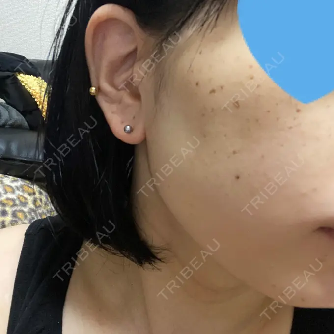 エレクトロポレーション / ピコスポット アモーレクリニック 名古屋院 DAY 5 メイン用