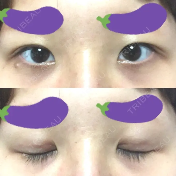 眼瞼下垂（切開） みずほクリニック DAY 63 メイン用