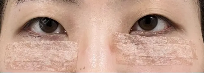 クマ治療 / 下まぶたの脂肪取り 吉井クリニック DAY 2 メイン用