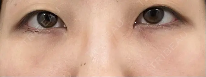 クマ治療 / 下まぶたの脂肪取り 吉井クリニック DAY 2 メイン用