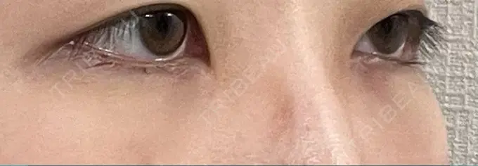 クマ治療 / 下まぶたの脂肪取り 吉井クリニック DAY 2 メイン用