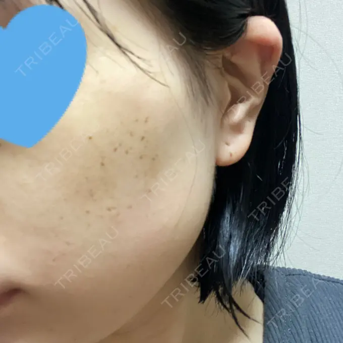 エレクトロポレーション / ピコスポット アモーレクリニック 名古屋院 DAY 6 メイン用