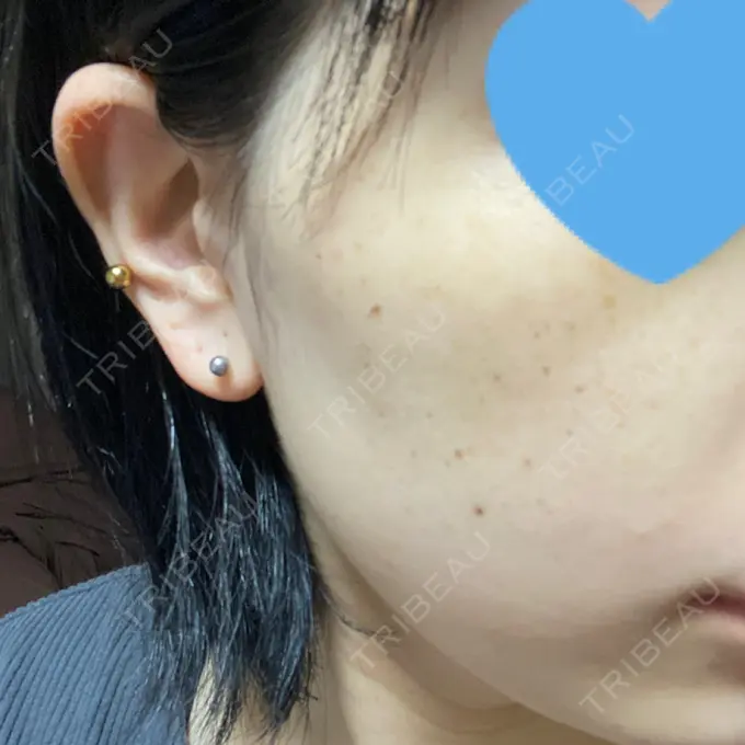 エレクトロポレーション / ピコスポット アモーレクリニック 名古屋院 DAY 6 メイン用