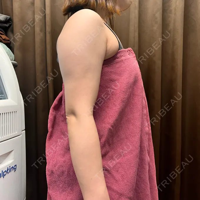 脂肪冷却（二の腕） KOSHOクリニック 本館 DAY 124 メイン用