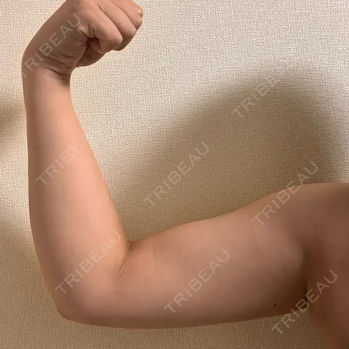 脂肪冷却（二の腕） KOSHOクリニック 本館 DAY 151 メイン用