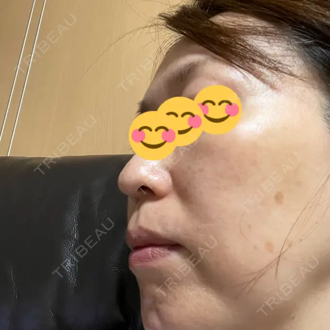 イオン導入 / ルメッカ ルラ美容クリニック 大宮院 / ルラスキンクリニック 大宮院 DAY 9 メイン用