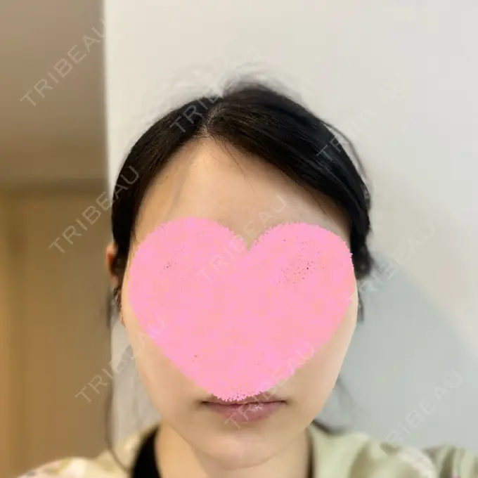 糸リフト / クマ治療 / 下まぶたの脂肪取り / ボトックス（額） Mods Clinic（モッズクリニック） 名古屋院 DAY 31 メイン用