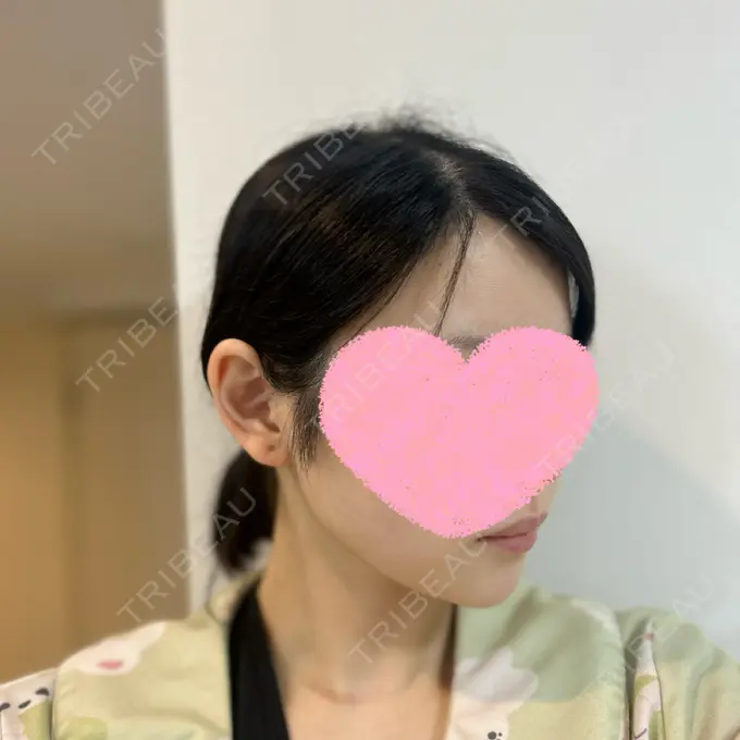 糸リフト / クマ治療 / 下まぶたの脂肪取り / ボトックス（額） Mods Clinic（モッズクリニック） 名古屋院 DAY 31 メイン用