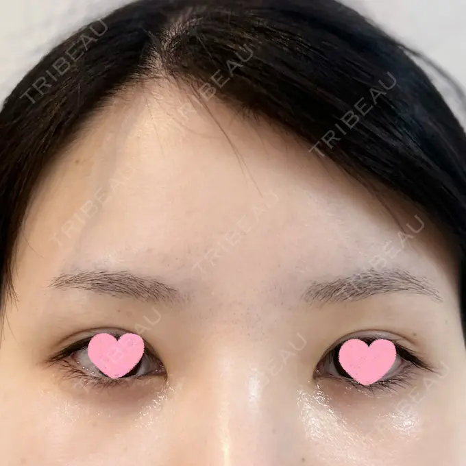 糸リフト / クマ治療 / 下まぶたの脂肪取り / ボトックス（額） Mods Clinic（モッズクリニック） 名古屋院 DAY 31 メイン用