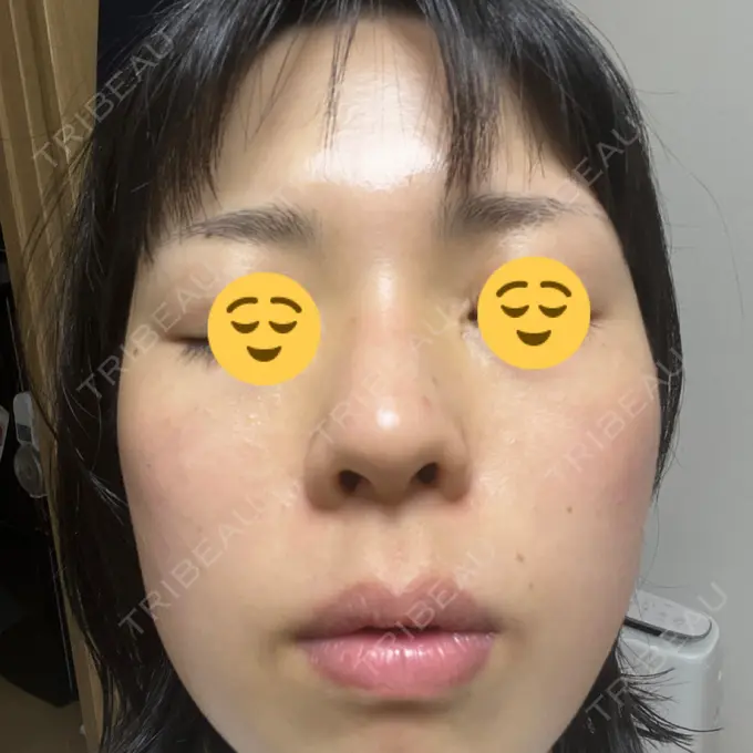 エレクトロポレーション / ピーリング（ハリ・ツヤ） ライズワン美容皮膚科クリニック DAY 0 メイン用