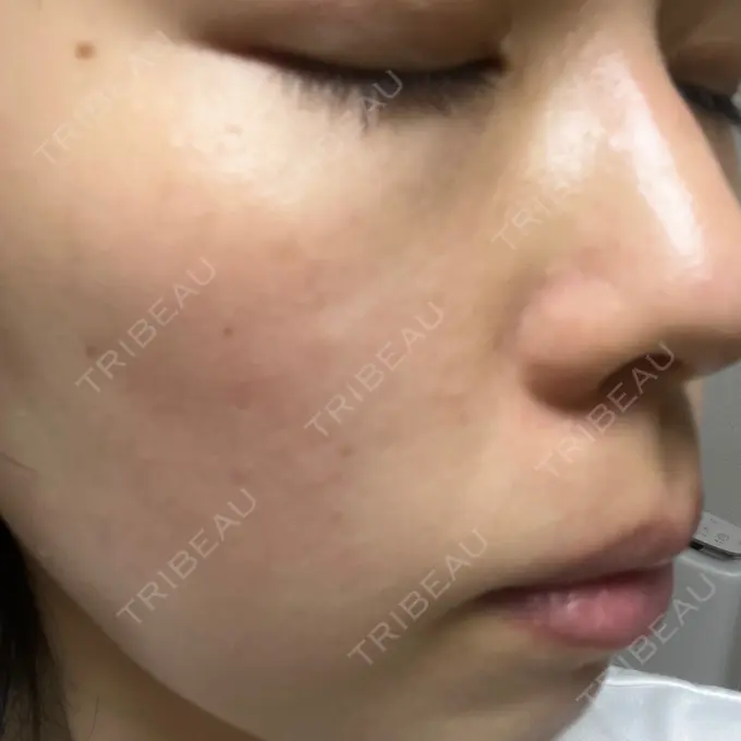 エレクトロポレーション / ピーリング（ハリ・ツヤ） ライズワン美容皮膚科クリニック DAY 0 メイン用