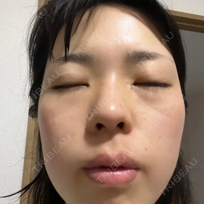 エレクトロポレーション / ピーリング（ハリ・ツヤ） ライズワン美容皮膚科クリニック DAY 1 メイン用