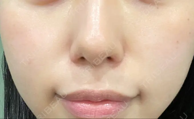 光治療（フォトフェイシャルなど） くさのたろうクリニック DAY 0 メイン用