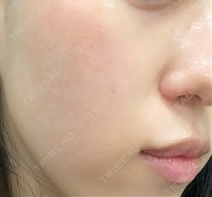 光治療（フォトフェイシャルなど） くさのたろうクリニック DAY 0 メイン用