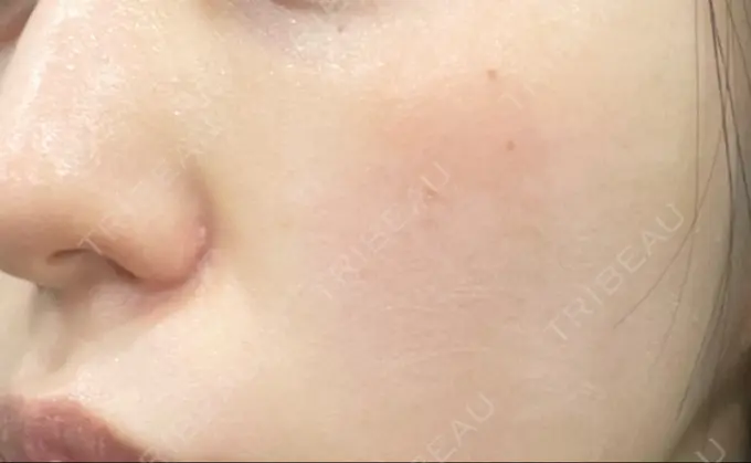 光治療（フォトフェイシャルなど） くさのたろうクリニック DAY 0 メイン用