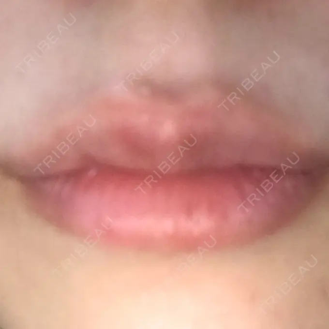 ヒアルロン酸注入（唇） LIKI CLINIC KOBE DAY 12 メイン用