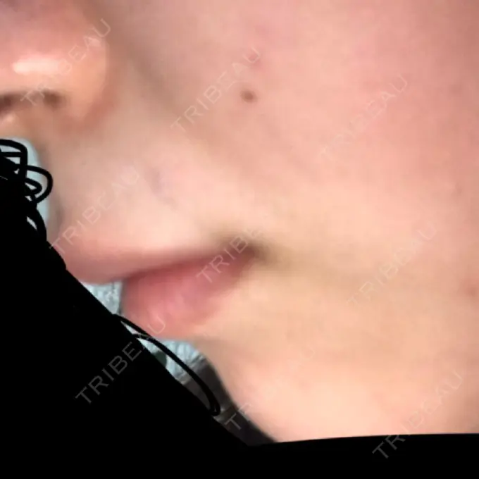 ヒアルロン酸注入（唇） LIKI CLINIC KOBE DAY 13 メイン用