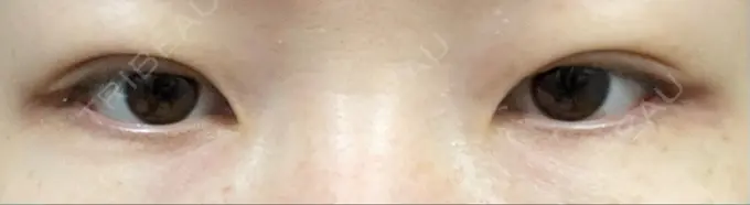 二重埋没 / ボトックス（エラ・小顔） 日本ウェルネス再生クリニック DAY 3 メイン用