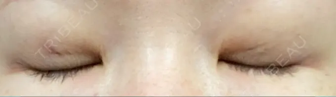 二重埋没 / ボトックス（エラ・小顔） 日本ウェルネス再生クリニック DAY 3 メイン用