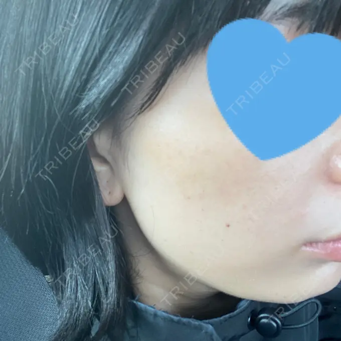 エレクトロポレーション / ピコスポット アモーレクリニック 名古屋院 DAY 7 メイン用