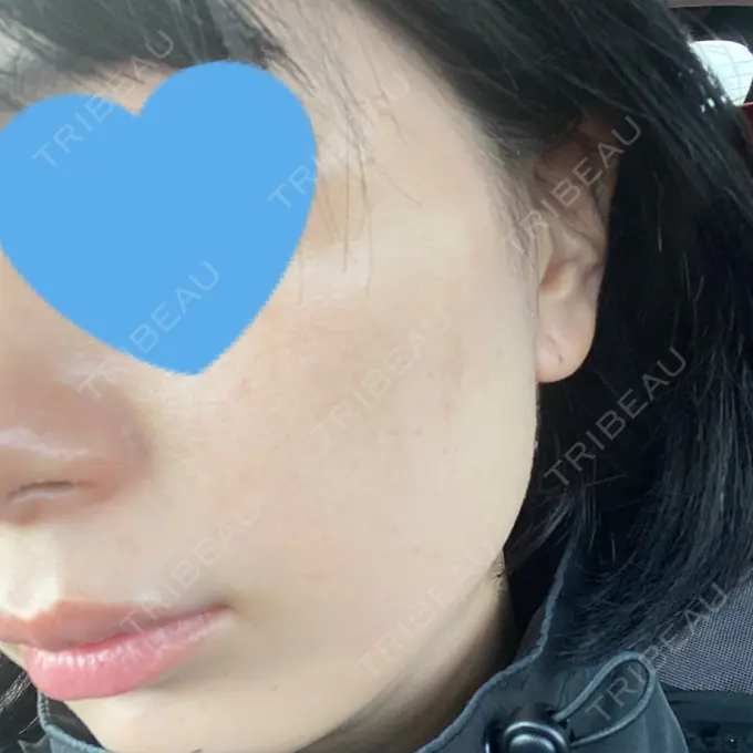 エレクトロポレーション / ピコスポット アモーレクリニック 名古屋院 DAY 7 メイン用