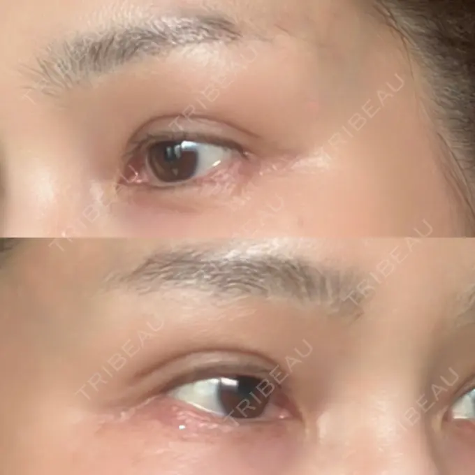 二重埋没 / 目元修正 オーキッド美容クリニック東京御徒町 DAY 70 メイン用