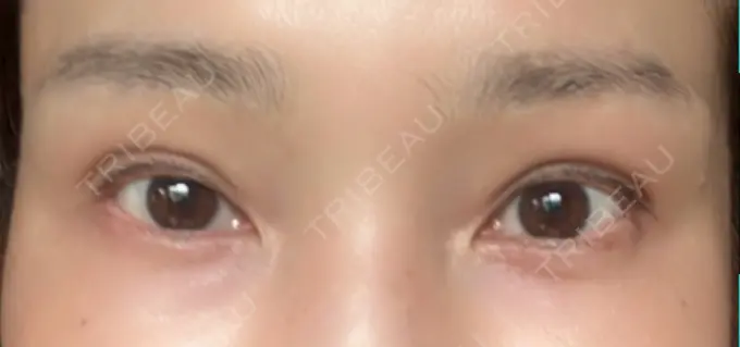 二重埋没 / 目元修正 オーキッド美容クリニック東京御徒町 DAY 70 メイン用