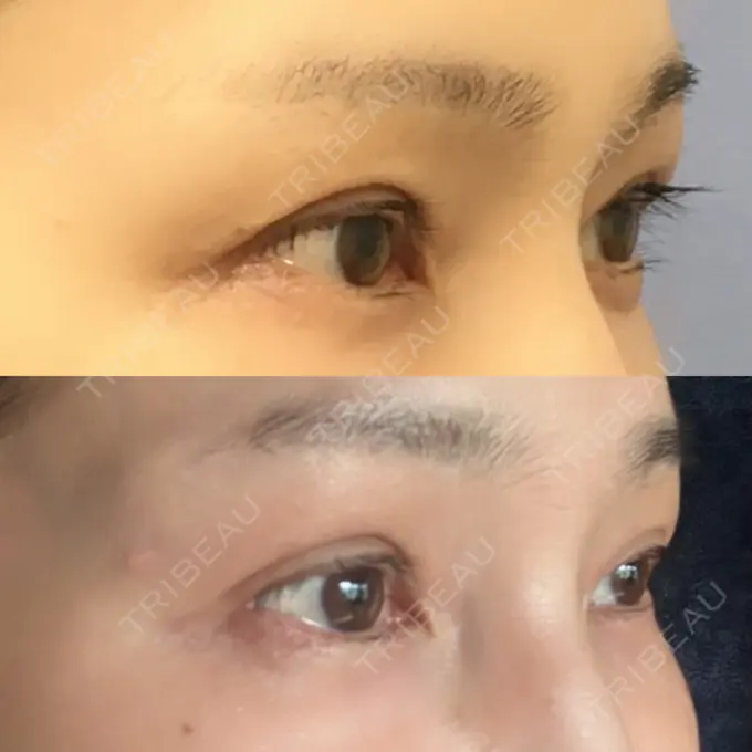 二重埋没 / 目元修正 オーキッド美容クリニック東京御徒町 DAY 70 メイン用