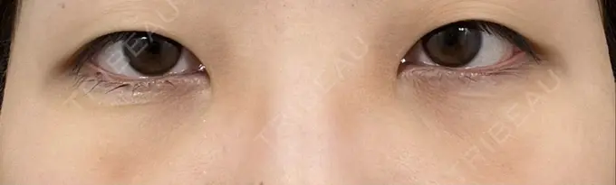 クマ治療 / 下まぶたの脂肪取り 吉井クリニック DAY 3 メイン用