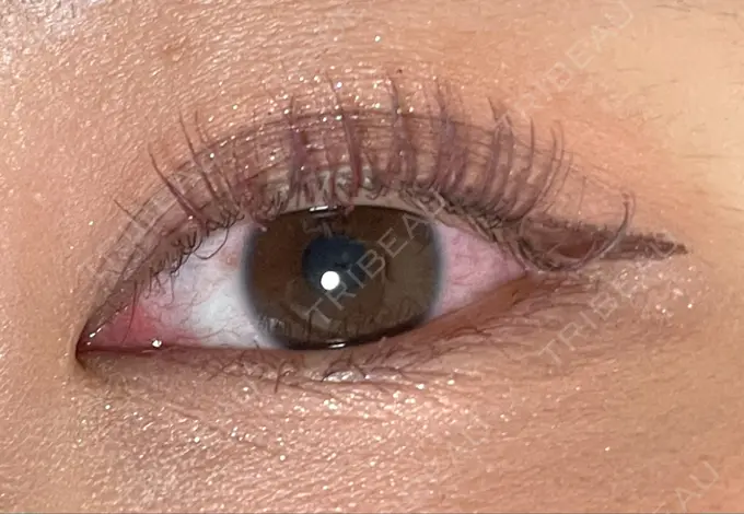 二重埋没 城本クリニック 福岡院 DAY 1056 メイン用