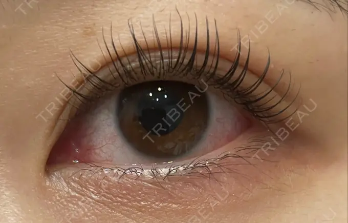 二重埋没 城本クリニック 福岡院 DAY 1056 メイン用