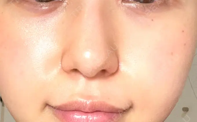 光治療（フォトフェイシャルなど） くさのたろうクリニック AFTER メイン用