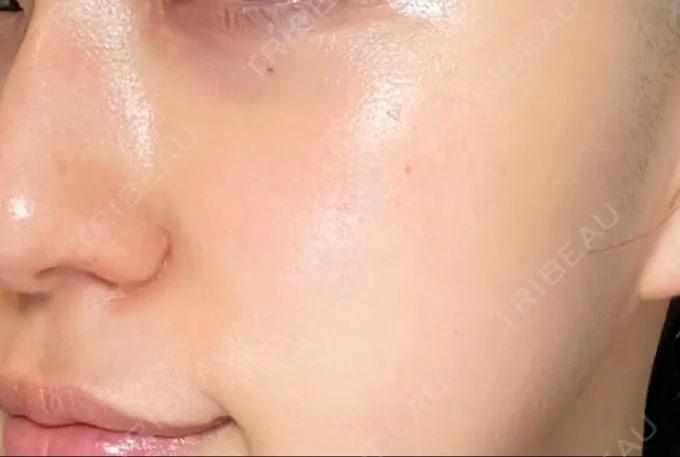 光治療（フォトフェイシャルなど） くさのたろうクリニック DAY 1 メイン用