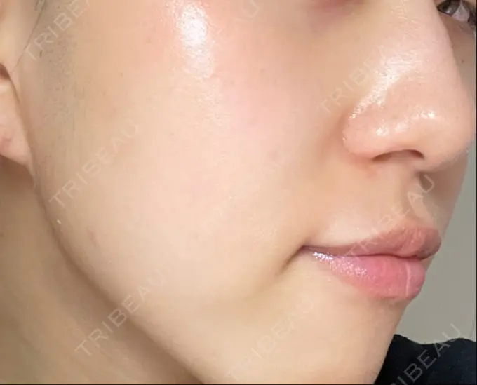 光治療（フォトフェイシャルなど） くさのたろうクリニック DAY 1 メイン用