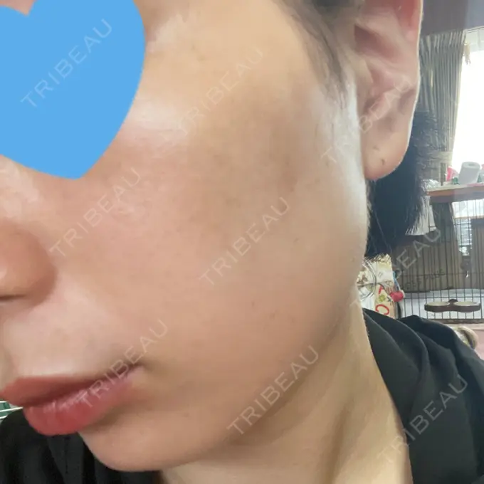 エレクトロポレーション / ピコスポット アモーレクリニック 名古屋院 DAY 8 メイン用