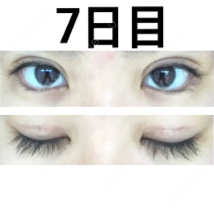 二重切開 みずほクリニック DAY 7 メイン用