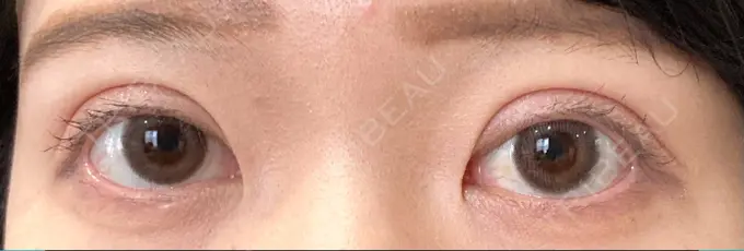 二重切開 / 目元修正 心斎橋コムロ美容外科クリニック DAY 232 メイン用