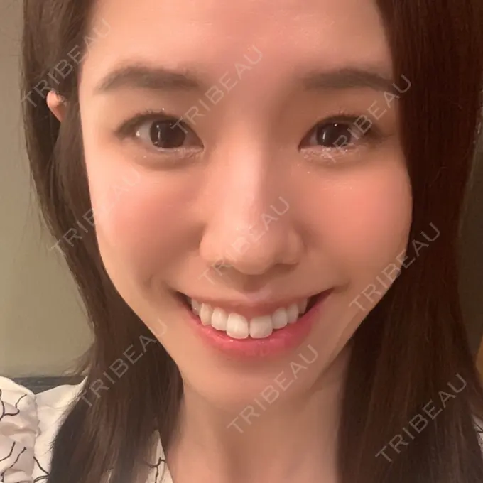 ホワイトニング 三鷹ヒロクリニック 北口院 （医療脱毛） AFTER メイン用