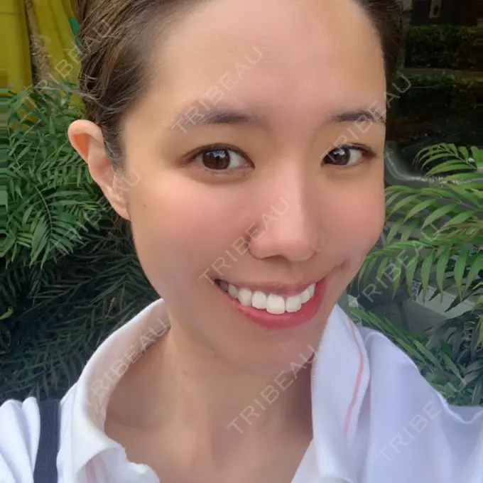 ホワイトニング 三鷹ヒロクリニック 北口院 （医療脱毛） DAY 2 メイン用